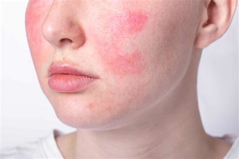 Levisa Lazer: The Unexpected Side Effects You Should Know - yjvds67