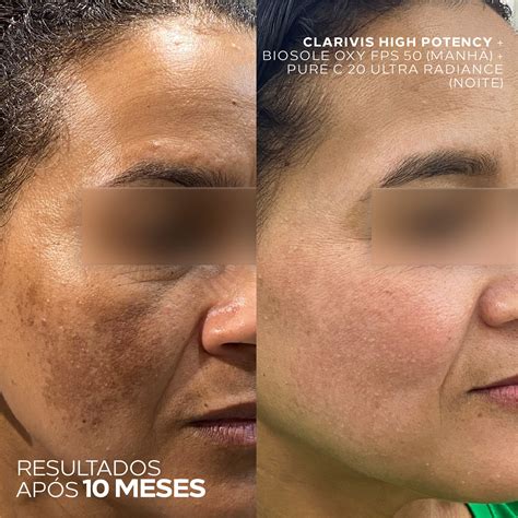 Serum Clareador Antes E Depois - Sérum Clareador de Manchas e Melasma - Alta Potência – ADA TINA
