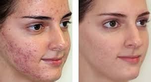 Acne Scars and IPL Treatments – Lasting Looks Toronto