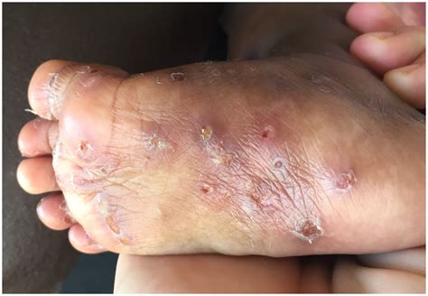 Scabies Bumps On Feet