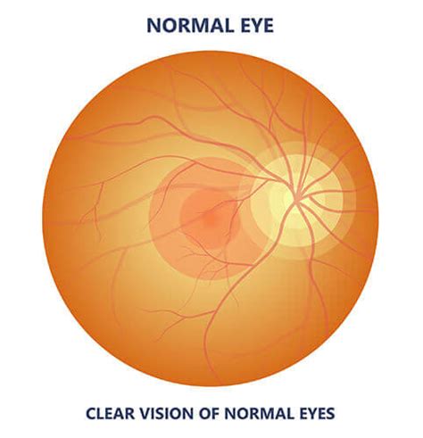 Macular Degeneration South Jersey | Eye Exam Camden County, NJ