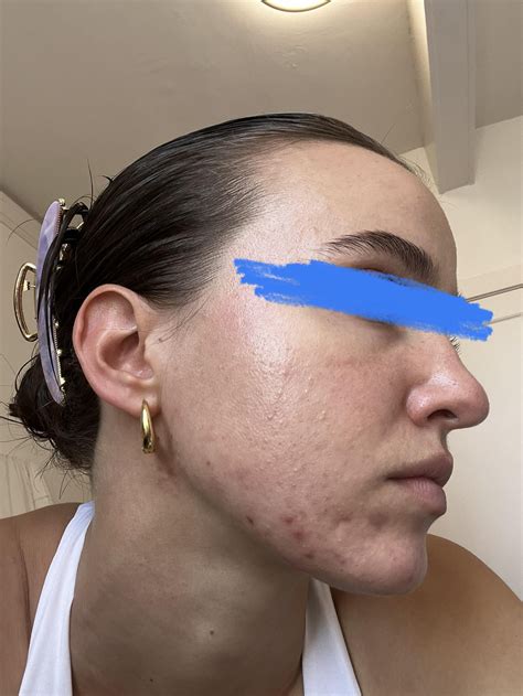 Hormonal Acne (routine in comments) : r/acne