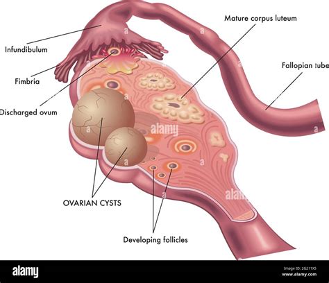 Fallopian tube cyst Stock Vector Images - Alamy