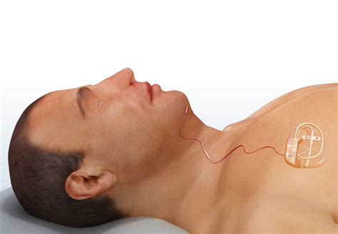 Inspire Upper Airway Stimulation - Sleep Doctor