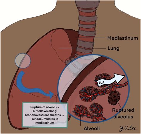 pneumomediastinum thoracic surgery clinics
