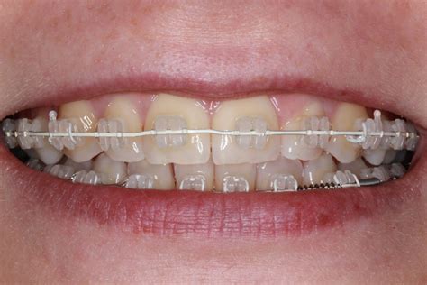 Ceramic Braces - Cost of Treatment - Kingston Orthodontics