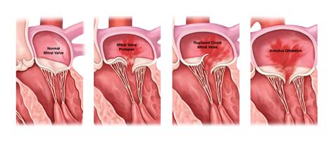 Is Mitral Valve Regurgitation Bad at Robin Alexander blog