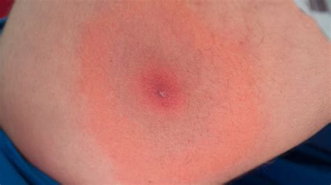 Deer Fly Bite