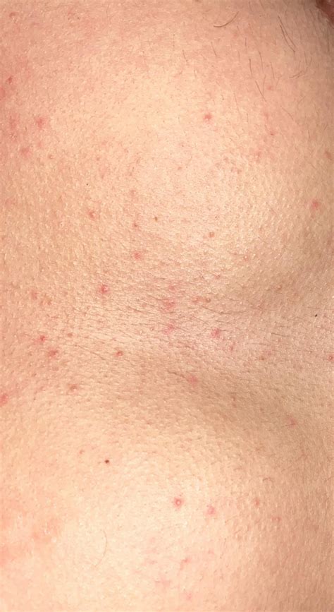 Does this look like a hiv rash? : r/HIV