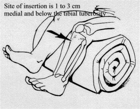 Medical & Beyond: INTRAOSSEOUS ACCESS