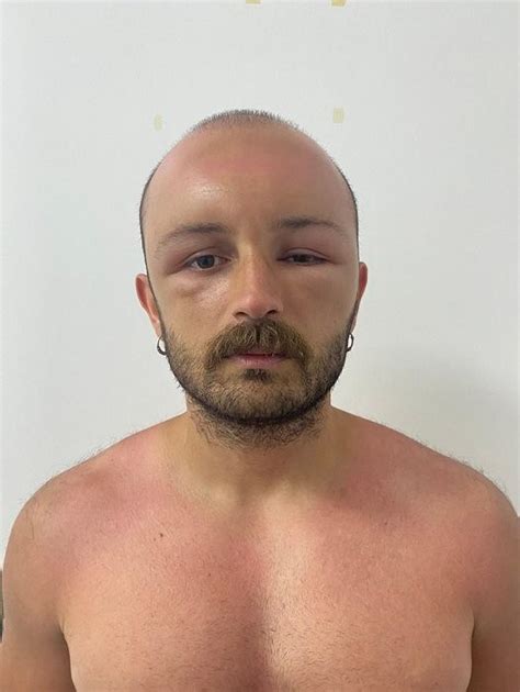 Man develops swollen head after day at the beach, stuns docs
