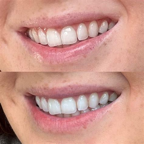 “I’ve tried so many whitening products, but nothing worked like this ...