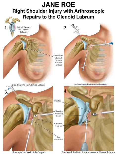 Right Shoulder Injury to Glenoid Labrum :: Behance