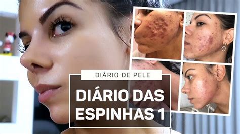 O Que Causa Espinhas No Rosto Depois Dos 30 Anos - Espinhas No Rosto Antes E Depois Como Identificar A Acne Fúngica