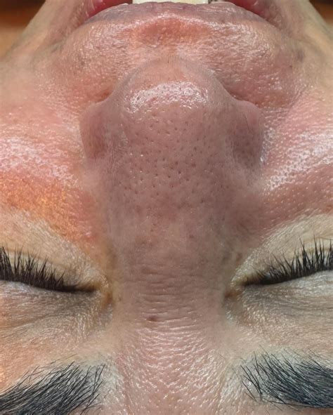The Surprising Truth About Unbelievable Blackhead Removal 2024. Image 1