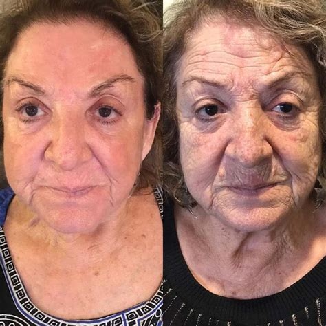 phenol peel   worth  risks results phenol peel