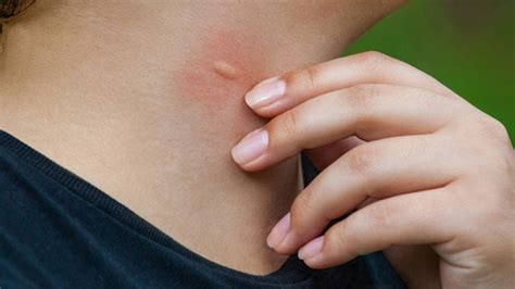 malaria diagnosis treatment mayo clinic