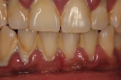 Teeth Cleaning Before And After