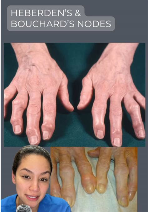 osteoarthritis finger nodules