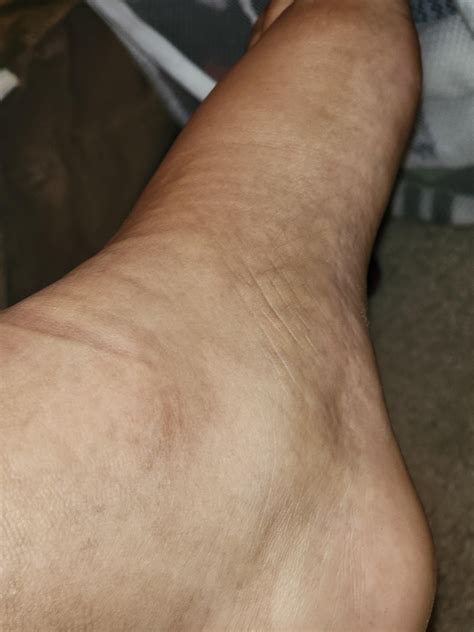 type 1 diabetic with grade 3 ankle sprain : r/medical