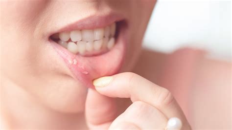 canker sores  treatment  prevention