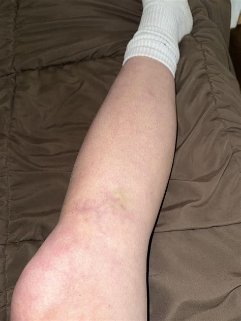 Knee bruising : r/Orthopedic