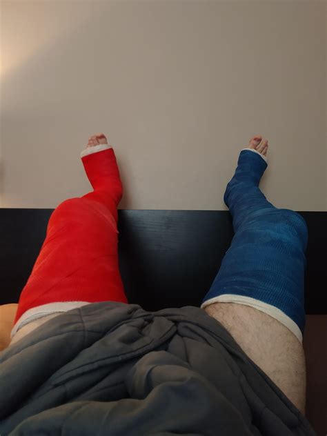 long leg cast | Tumblr