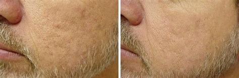 Laser Genesis Before and After photo gallery