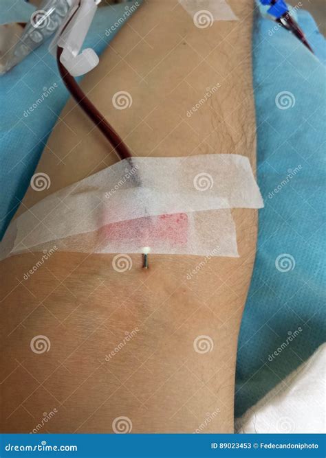 Arm of a Man at the Hospital when Donating Blood with the Needle Stock