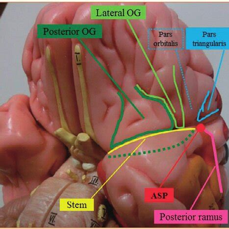 aAnatomy of the sylvian fissure stem. The sylvian fissure is divided... | Download Scientific ...