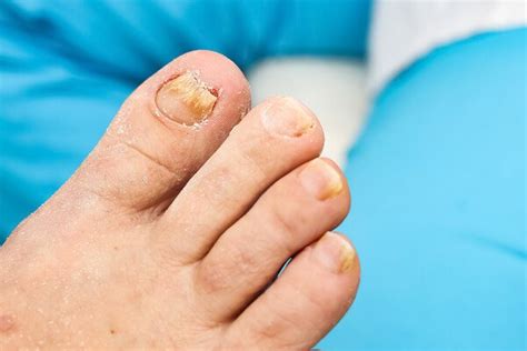 Toenail Fungus Treatment – What Are My Options? — FOOT, 60% OFF