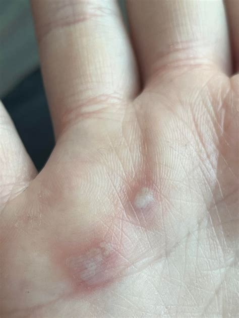 Anyone ever experienced this before? Blister type bumps on palm