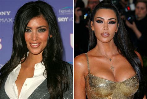 Worst Plastic Surgery Before And After