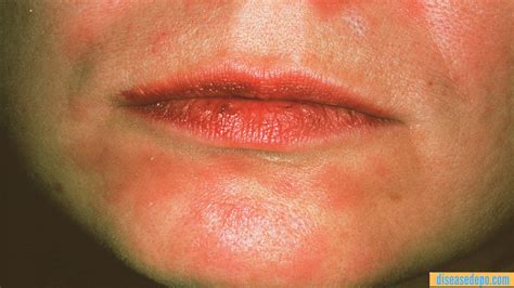 syphilis
