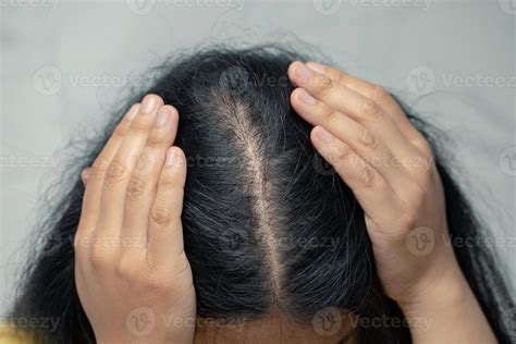 Woman hair loss from shampoo allergy. 13121801 Stock Photo at Vecteezy