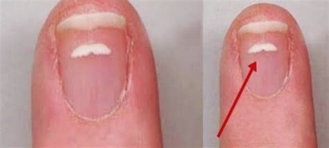 Unhas Brancas O Que Pode Ser - Mancha Branca na Unha: O Que Pode Ser?