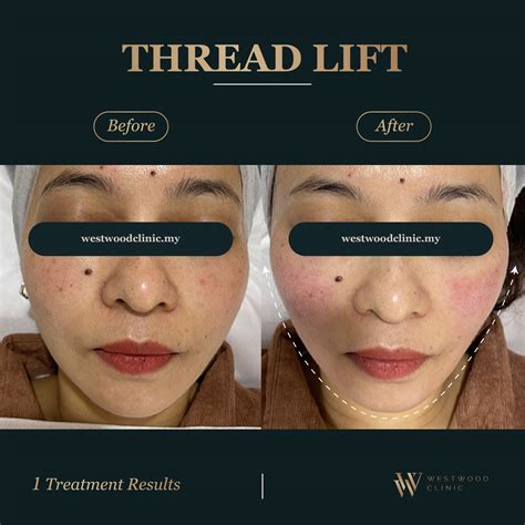 advanced thread lift therapy westwood clinic