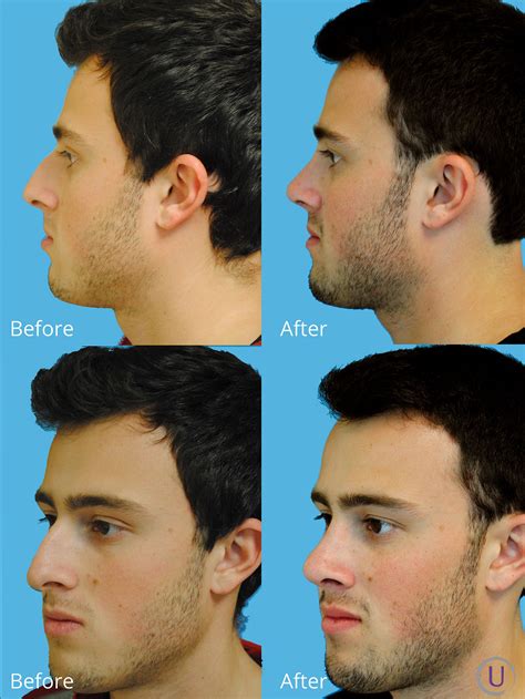 He was unhappy with his dorsal hump. 6 months post op. Nose Jobs, Nose ...