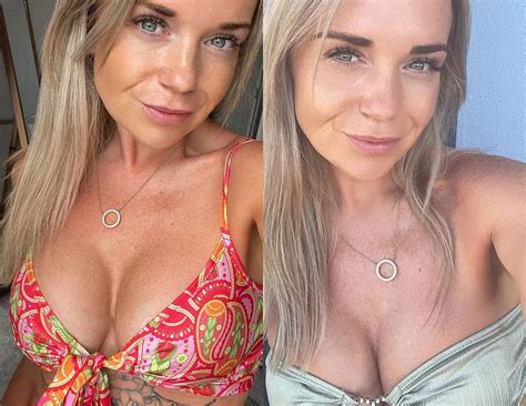 Breast Enlargement - Nationwide Provider | Enhance Med