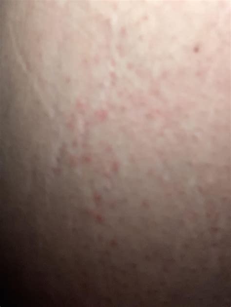 Does this look like a scabies burrow? : r/scabies