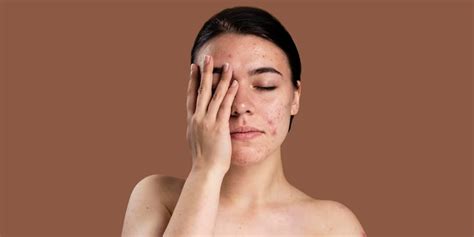 hormonal acne