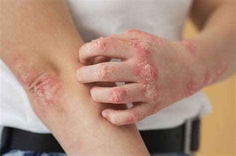 Penyakit Kulit Psoriasis Apakah Menular? Ini Penjelasan Dokter Kulit ...