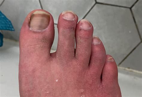 What is wrong with my toenails? : r/HealthQuestions