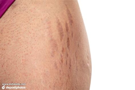 O'que Causa Estrias Roxas - Estrias: causas, prevenção e tratamento