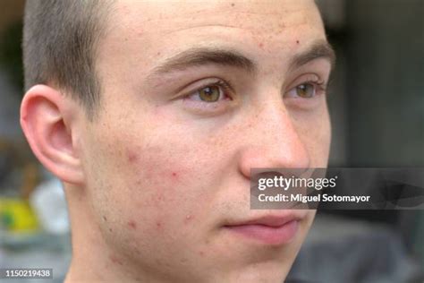 male acne   premium high res pictures getty images