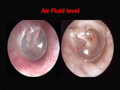 otitis media  effusion