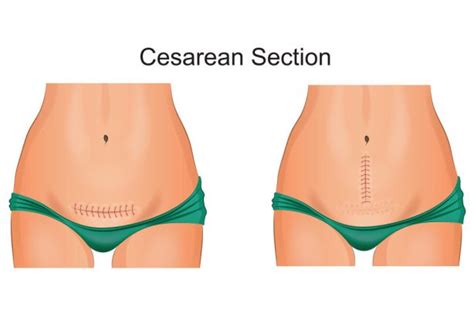 C-section Delivery- Procedure, Reasons, Recovery & more