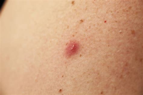 60+ Smallpox Pustules Stock Photos, Pictures & Royalty-Free Images - iStock