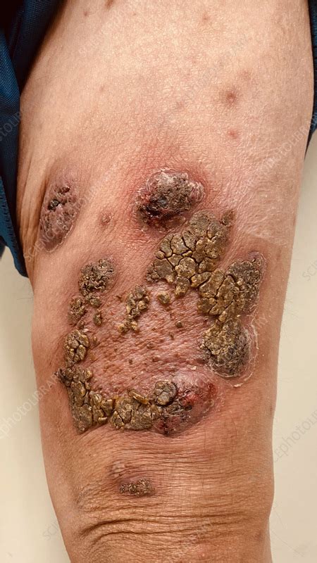 Pyoderma gangrenosum - Stock Image - C057/2266 - Science Photo Library