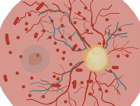 retinal vein occlusion